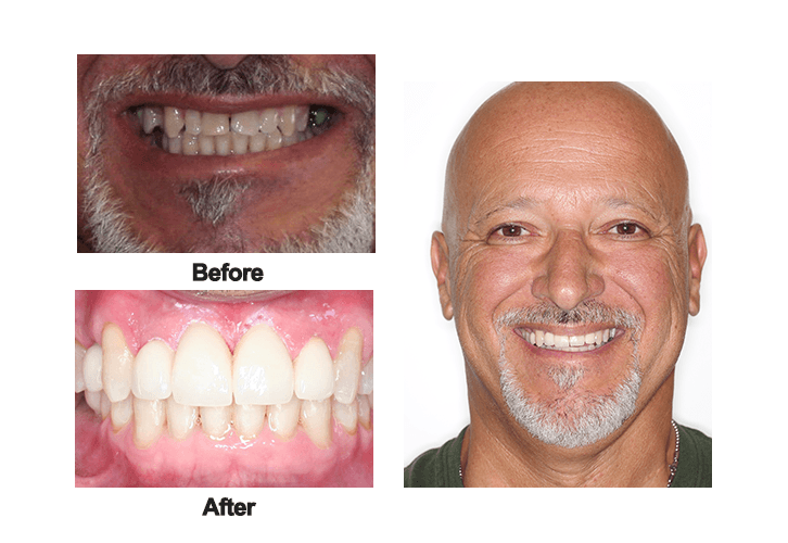 Angelo Before and After teeth