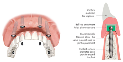 Bird Rock Dental Implant Dentures Diagram