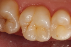 Crowns Case 1 before