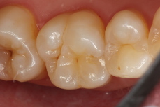 Crowns Case 1 after