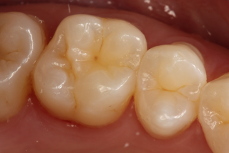 Crowns Case 2 before