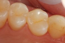 Fillings 4