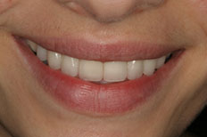 Veneers case 1 after