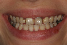 Veneers Case 1 before