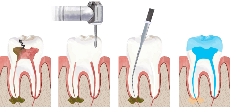 Bird Rock Dental Root Canal Therapy Procedure