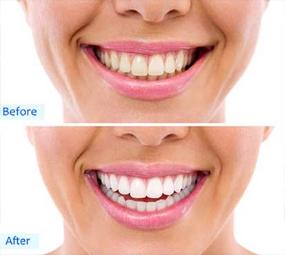 Bird Rock Dental Teeth Whitening